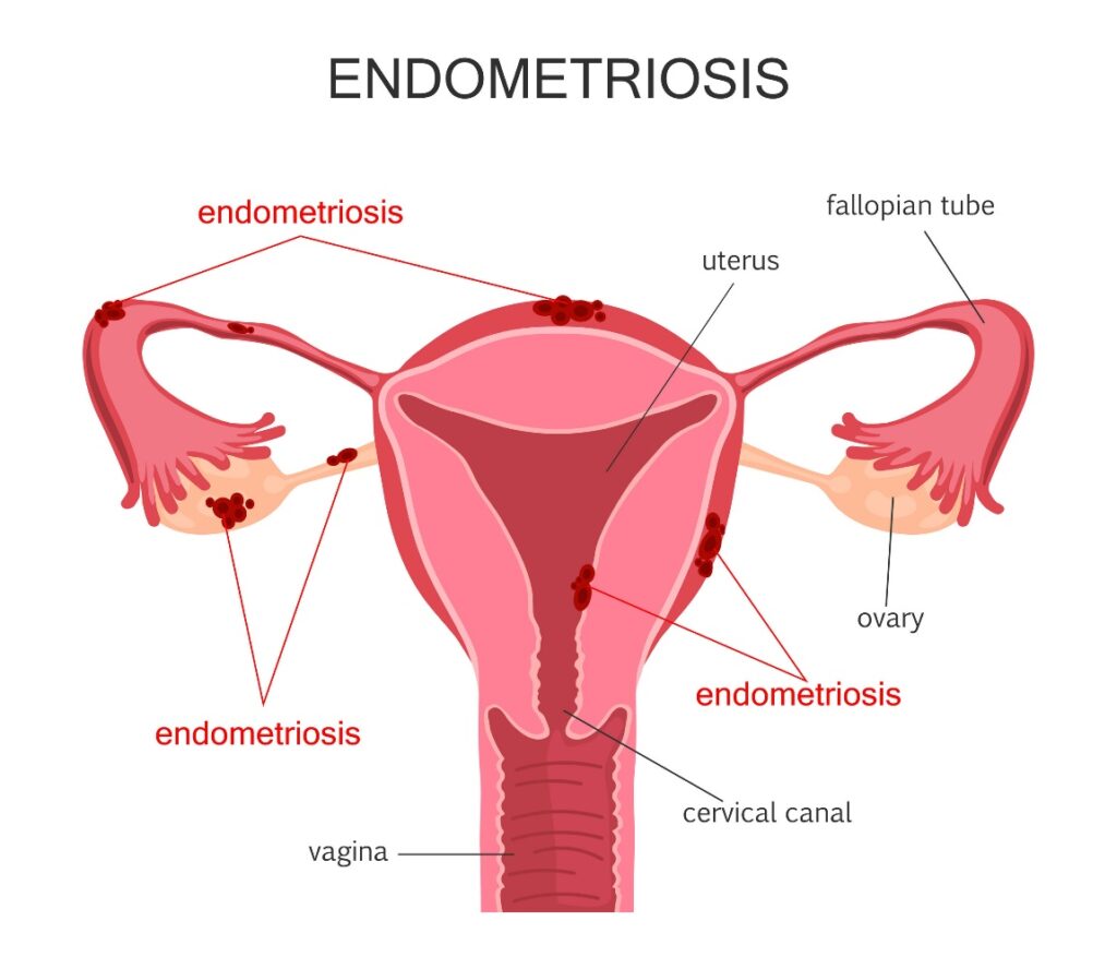 Endometrioza | Biota intima